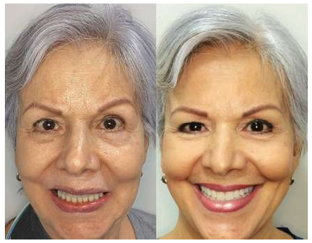 Antes y después